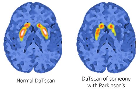 parkinson brain scan dat scan